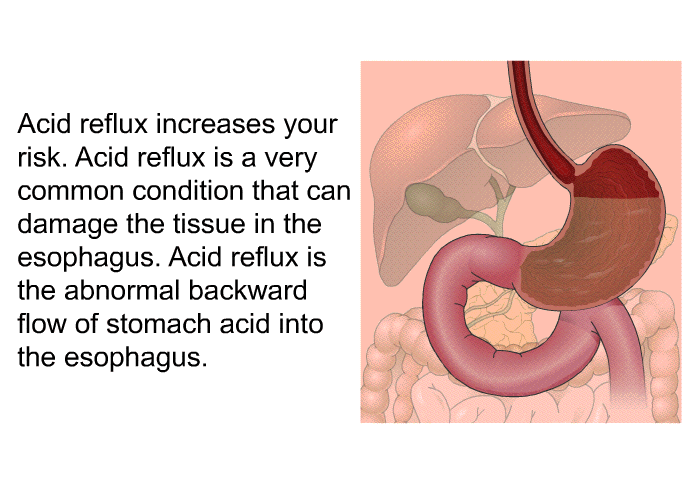 Acid reflux increases your risk. Acid reflux is a very common condition that can damage the tissue in the esophagus. Acid reflux is the abnormal backward flow of stomach acid into the esophagus.