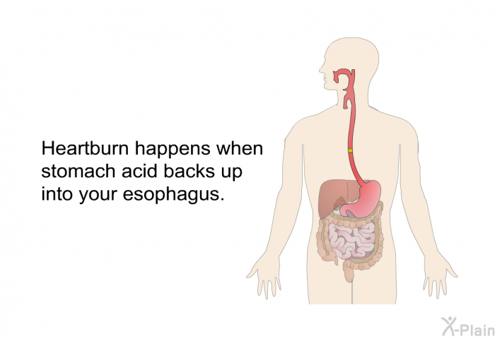 Heartburn happens when stomach acid backs up into your esophagus.