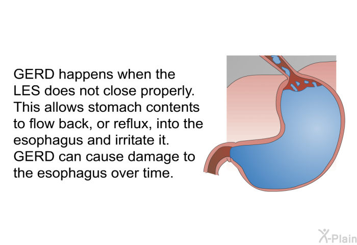 GERD happens when the LES does not close properly. This allows stomach contents to flow back, or reflux, into the esophagus and irritate it. GERD can cause damage to the esophagus over time.