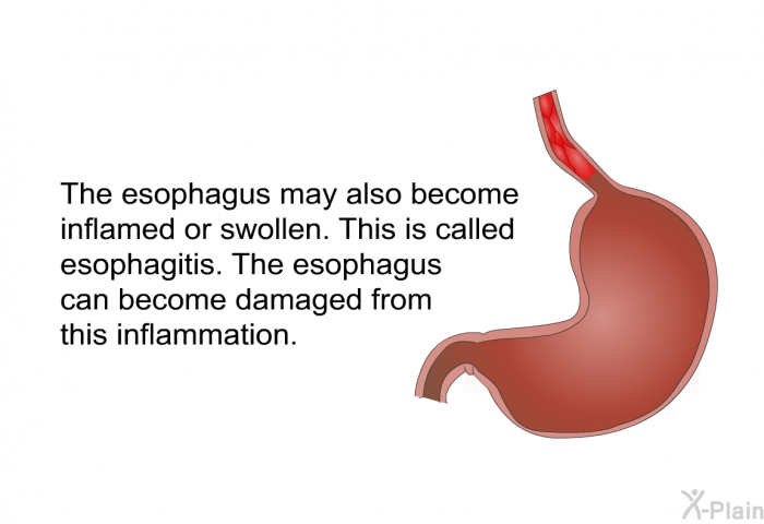 The esophagus may also become inflamed or swollen. This is called esophagitis. The esophagus can become damaged from this inflammation.