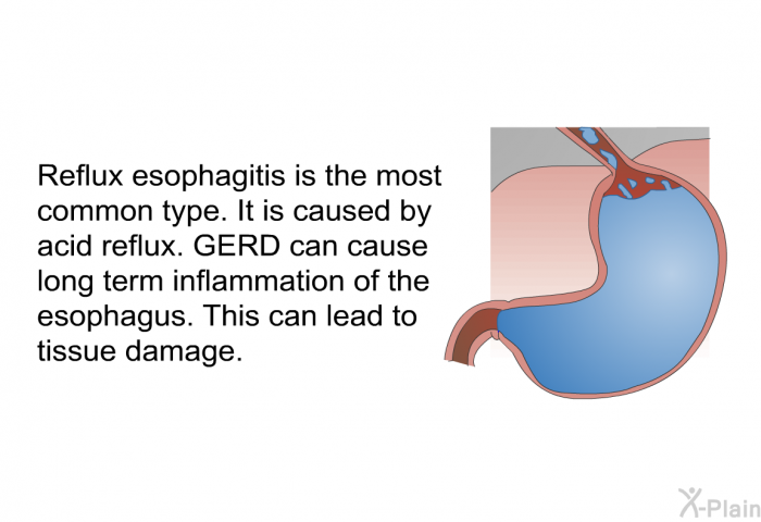 Reflux esophagitis is the most common type. It is caused by acid reflux. GERD can cause long term inflammation of the esophagus. This can lead to tissue damage.