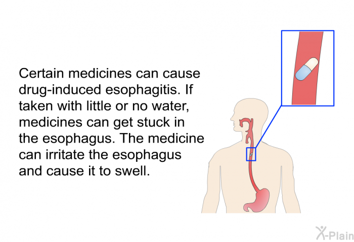 Certain medicines can cause drug-induced esophagitis. If taken with little or no water, medicines can get stuck in the esophagus. The medicine can irritate the esophagus and cause it to swell.