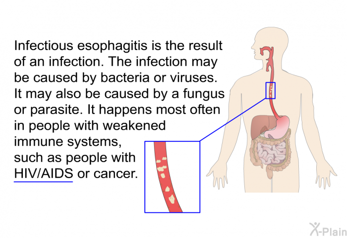 Infectious esophagitis is the result of an infection. The infection may be caused by bacteria or viruses. It may also be caused by a fungus or parasite. It happens most often in people with weakened immune systems, such as people with HIV/AIDS or cancer.