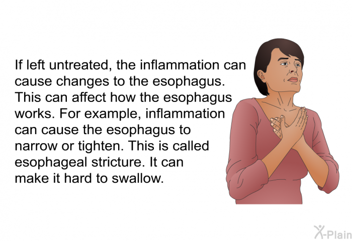 If left untreated, the inflammation can cause changes to the esophagus. This can affect how the esophagus works. For example, inflammation can cause the esophagus to narrow or tighten. This is called esophageal stricture. It can make it hard to swallow.