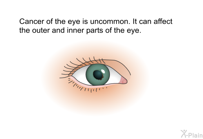 Cancer of the eye is uncommon. It can affect the outer and inner parts of the eye.