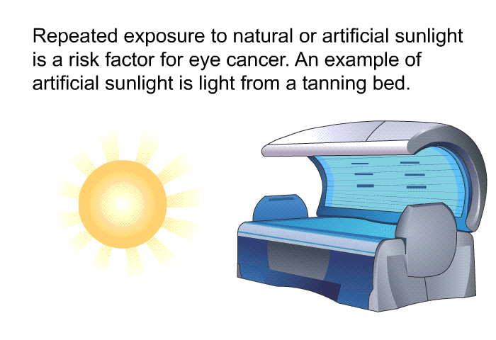 Repeated exposure to natural or artificial sunlight is a risk factor for eye cancer. An example of artificial sunlight is light from a tanning bed.