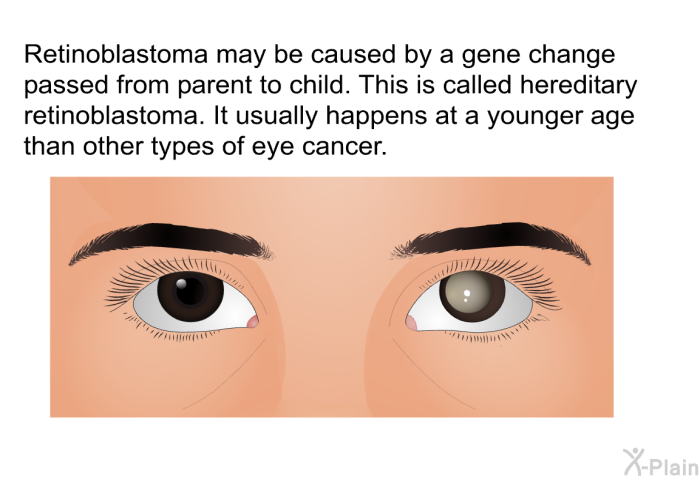 Retinoblastoma may be caused by a gene change passed from parent to child. This is called hereditary retinoblastoma. It usually happens at a younger age than other types of eye cancer.