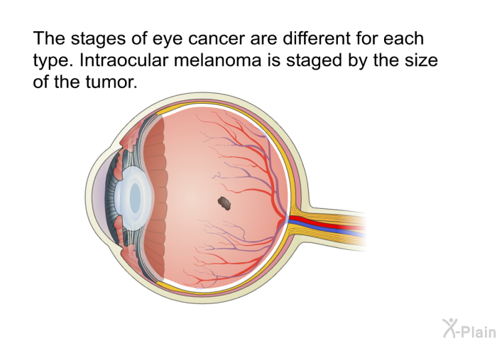 The stages of eye cancer are different for each type. Intraocular melanoma is staged by the size of the tumor.