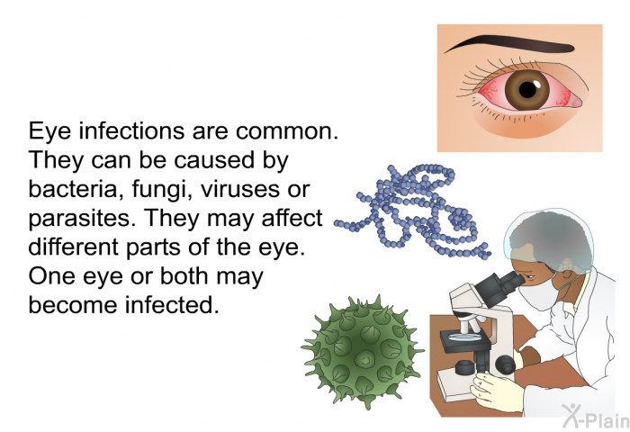 Eye infections are common. They can be caused by bacteria, fungi, viruses or parasites. They may affect different parts of the eye. One eye or both may become infected.