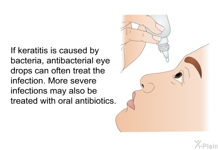 If keratitis is caused by bacteria, antibacterial eye drops can often treat the infection. More severe infections may also be treated with oral antibiotics.