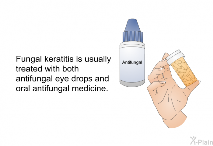 Fungal keratitis is usually treated with both antifungal eye drops and oral antifungal medicine.