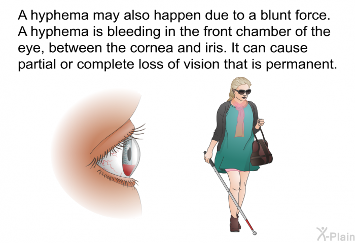 A hyphema may also happen due to a blunt force. A hyphema is bleeding in the front chamber of the eye, between the cornea and iris. It can cause partial or complete loss of vision that is permanent.