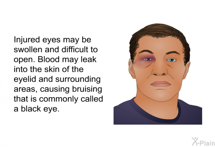 Injured eyes may be swollen and difficult to open. Blood may leak into the skin of the eyelid and surrounding areas, causing bruising that is commonly called a black eye.