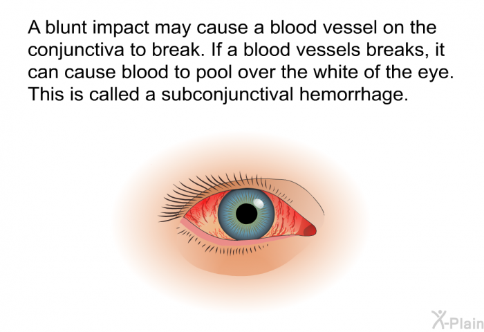 A blunt impact may cause a blood vessel on the conjunctiva to break. If a blood vessels breaks, it can cause blood to pool over the white of the eye. This is called a subconjunctival hemorrhage.