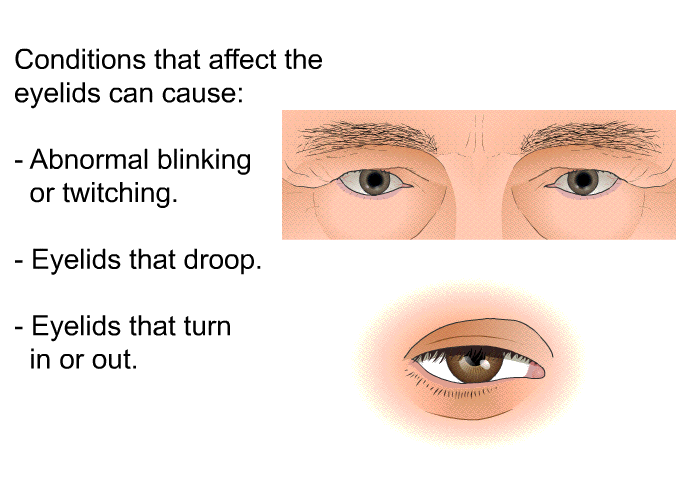 Conditions that affect the eyelids can cause:  Abnormal blinking or twitching. Eyelids that droop. Eyelids that turn in or out.
