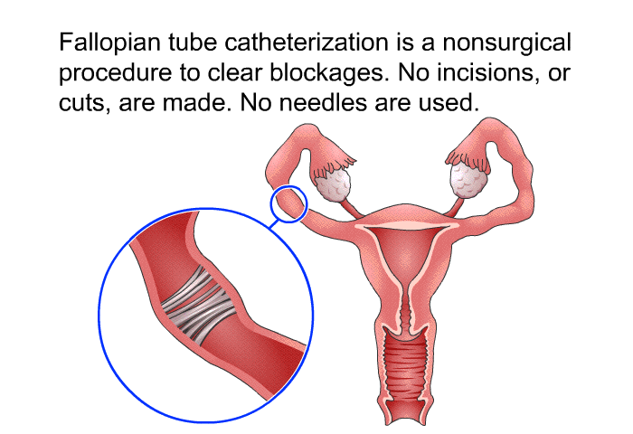 Fallopian tube catheterization is a nonsurgical procedure to clear blockages. No incisions, or cuts, are made. No needles are used.