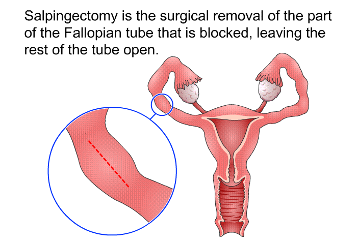 Salpingectomy is the surgical removal of the part of the Fallopian tube that is blocked, leaving the rest of the tube open.