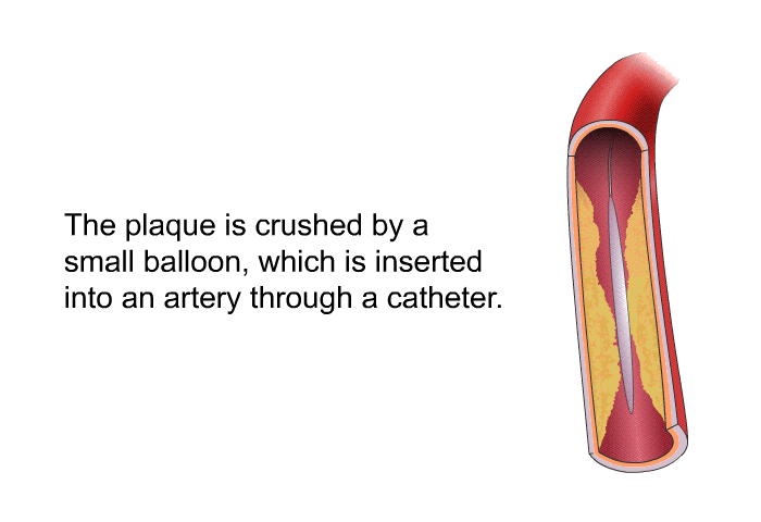 The plaque is crushed by a small balloon, which is inserted into an artery through a catheter.