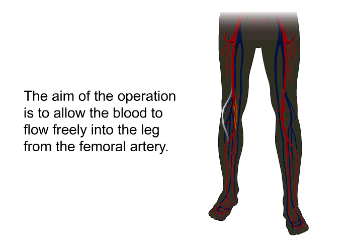 The aim of the operation is to allow the blood to flow freely into the leg from the femoral artery.