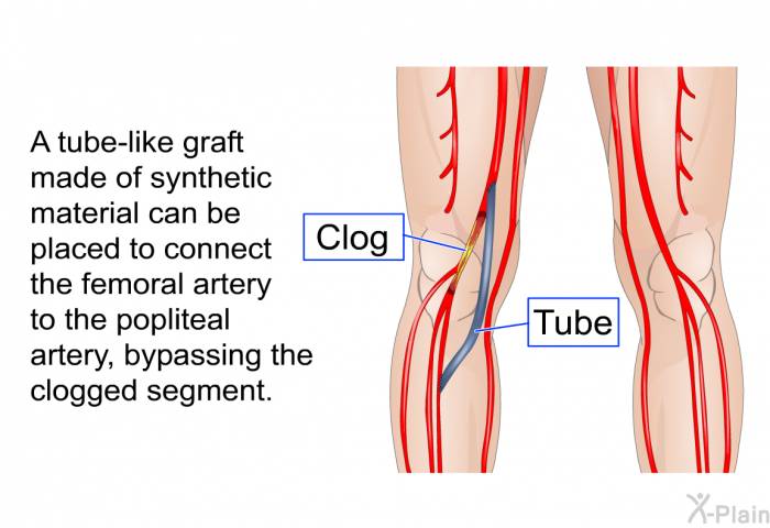 A tube-like graft made of synthetic material can be placed to connect the femoral artery to the popliteal artery, bypassing the clogged segment.
