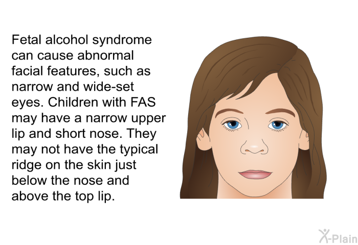 Fetal alcohol syndrome can cause abnormal facial features, such as narrow and wide-set eyes. Children with FAS may have a narrow upper lip and short nose. They may not have the typical ridge on the skin just below the nose and above the top lip.