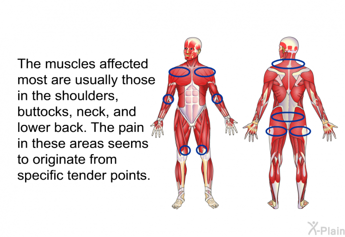 The muscles affected most are usually those in the shoulders, buttocks, neck, and lower back. The pain in these areas seems to originate from specific tender points.
