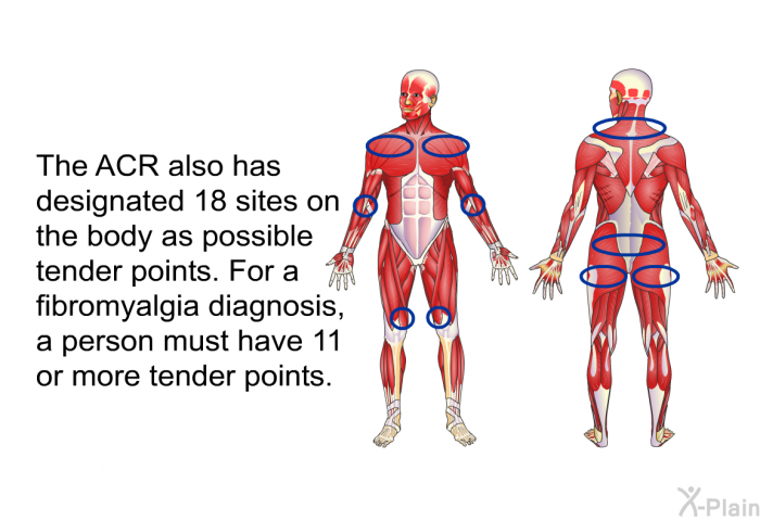 The ACR also has designated 18 sites on the body as possible tender points. For a fibromyalgia diagnosis, a person must have 11 or more tender points.