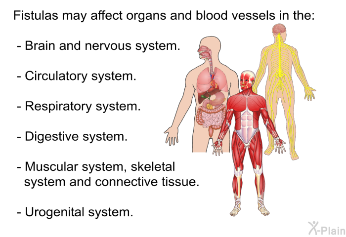Fistulas may affect organs and blood vessels in the:  Brain and nervous system. Circulatory system. Respiratory system. Digestive system. Muscular system, skeletal system and connective tissue. Urogenital system.