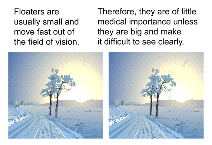 Floaters are usually small and move fast out of the field of vision. Therefore, they are of little medical importance unless they are big and make it difficult to see clearly.