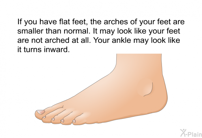 If you have flat feet, the arches of your feet are smaller than normal. It may look like your feet are not arched at all. Your ankle may look like it turns inward.