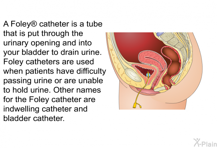 A Foley  catheter is a tube that is put through the urinary opening and into your bladder to drain urine. Foley catheters are used when patients have difficulty passing urine or are unable to hold urine. Other names for the Foley catheter are indwelling catheter and bladder catheter.