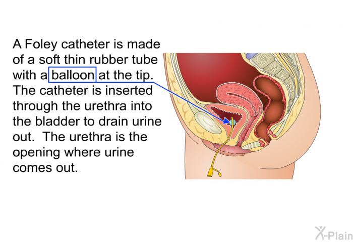 A Foley catheter is made of a soft thin rubber tube with a balloon at the tip. The catheter is inserted through the urethra into the bladder to drain urine out. The urethra is the opening where urine comes out.