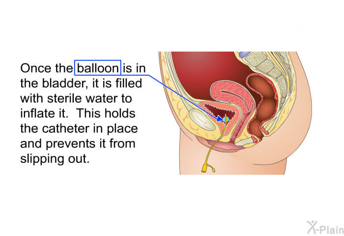 Once the balloon is in the bladder, it is filled with sterile water to inflate it. This holds the catheter in place and prevents it from slipping out.