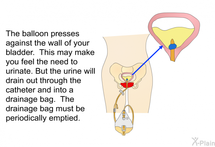 The balloon presses against the wall of your bladder. This may make you feel the need to urinate. But the urine will drain out through the catheter and into a drainage bag. The drainage bag must be periodically emptied.