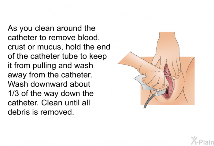 As you clean around the catheter to remove blood, crust or mucus, hold the end of the catheter tube to keep it from pulling and wash away from the catheter. Wash downward about 1/3 of the way down the catheter. Clean until all debris is removed.
