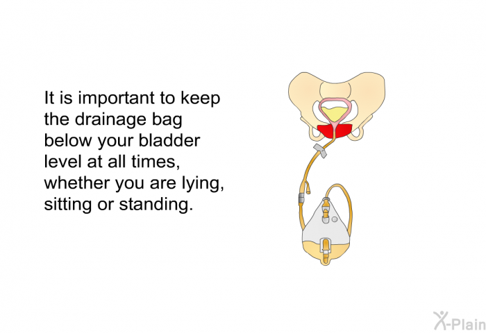 It is important to keep the drainage bag below your bladder level at all times, whether you are lying, sitting or standing.