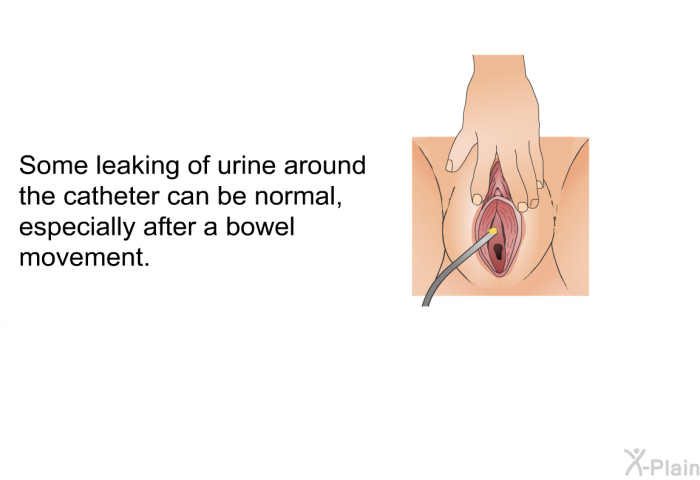 Some leaking of urine around the catheter can be normal, especially after a bowel movement.
