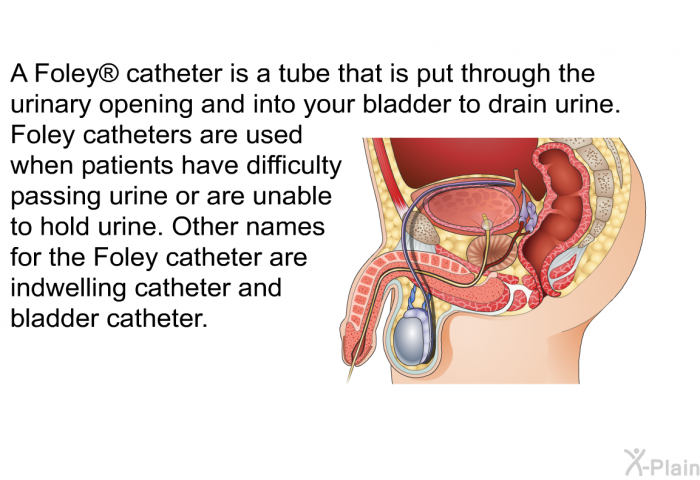 A Foley  catheter is a tube that is put through the urinary opening and into your bladder to drain urine. Foley catheters are used when patients have difficulty passing urine or are unable to hold urine. Other names for the Foley catheter are indwelling catheter and bladder catheter.