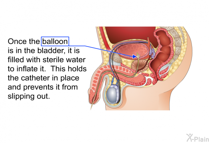 Once the balloon is in the bladder, it is filled with sterile water to inflate it. This holds the catheter in place and prevents it from slipping out.