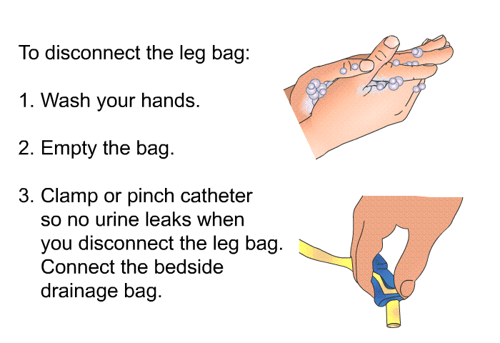 To disconnect the leg bag:  Wash your hands. Empty the bag. Clamp or pinch catheter so no urine leaks when you disconnect the leg bag. Connect the bedside drainage bag.