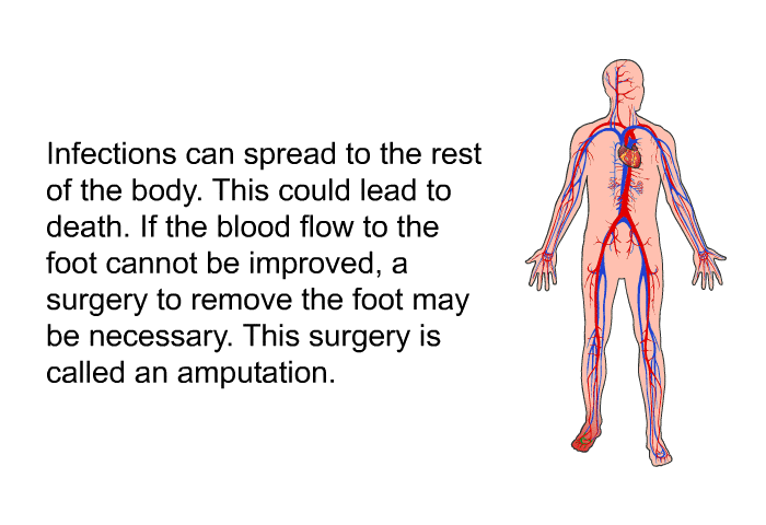 Infections can spread to the rest of the body. This could lead to death. If the blood flow to the foot cannot be improved, a surgery to remove the foot may be necessary. This surgery is called an amputation.