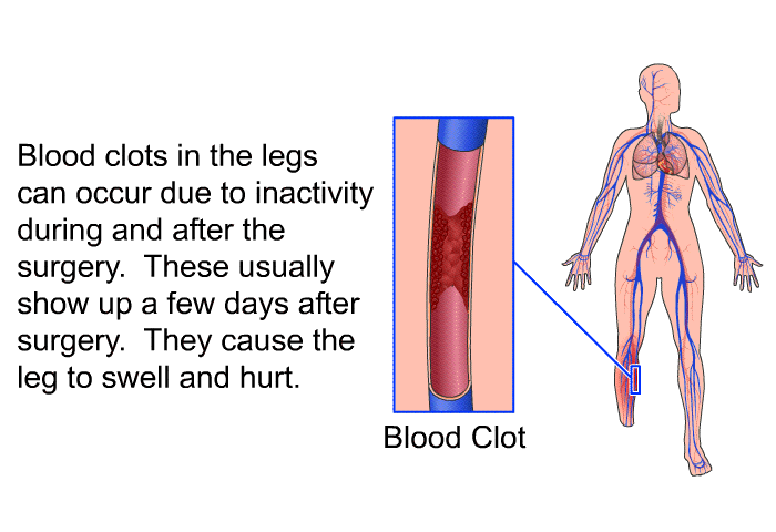 Blood clots in the legs can occur due to inactivity during and after the surgery. These usually show up a few days after surgery. They cause the leg to swell and hurt.