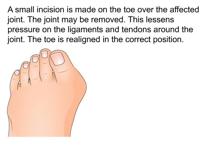 A small incision is made on the toe over the affected joint. The joint may be removed. This lessens pressure on the ligaments and tendons around the joint. The toe is realigned in the correct position.