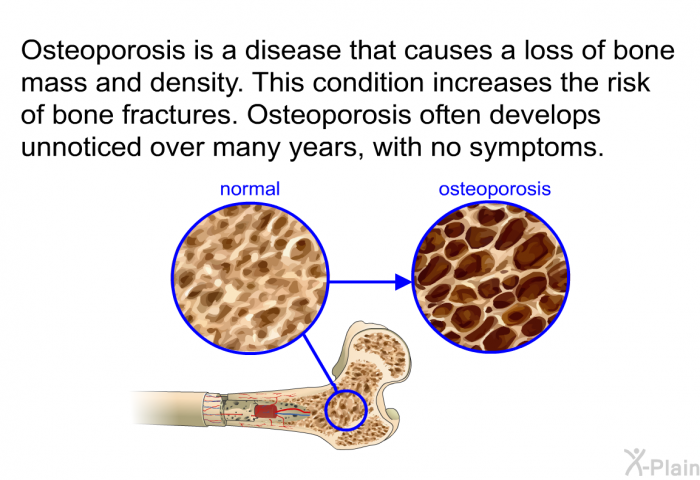 Osteoporosis is a disease that causes a loss of bone mass and density. This condition increases the risk of bone fractures. Osteoporosis often develops unnoticed over many years, with no symptoms.