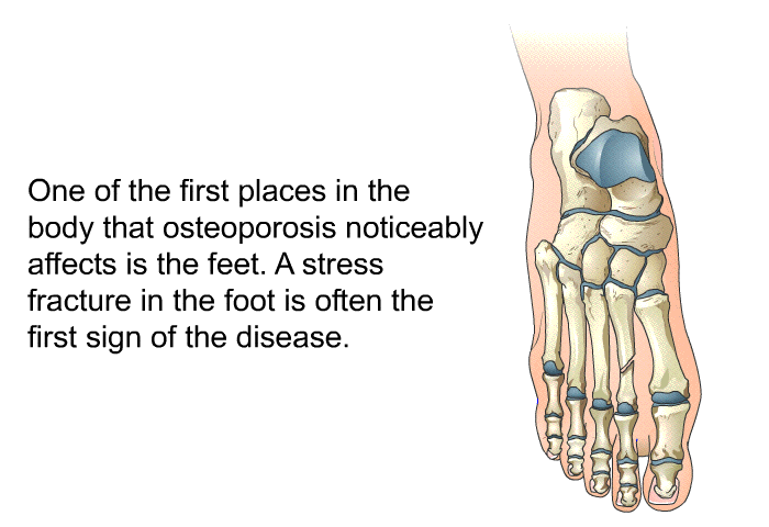 One of the first places in the body that osteoporosis noticeably affects is the feet. A stress fracture in the foot is often the first sign of the disease.