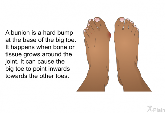 A bunion is a hard bump at the base of the big toe. It happens when bone or tissue grows around the joint. It can cause the big toe to point inwards towards the other toes.