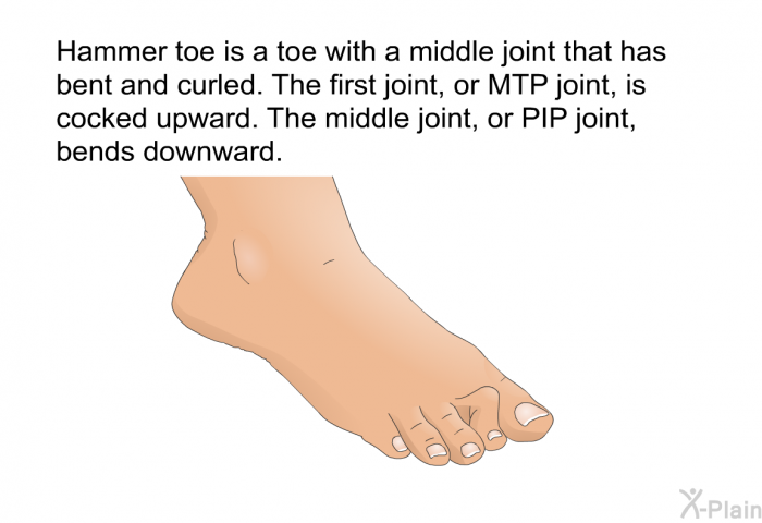 Hammer toe is a toe with a middle joint that has bent and curled. The first joint, or MTP joint, is cocked upward. The middle joint, or PIP joint, bends downward.