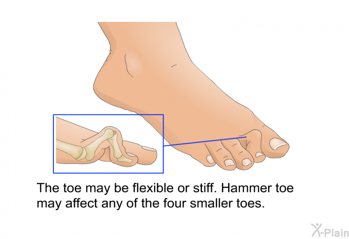 The toe may be flexible or stiff. Hammer toe may affect any of the four smaller toes.