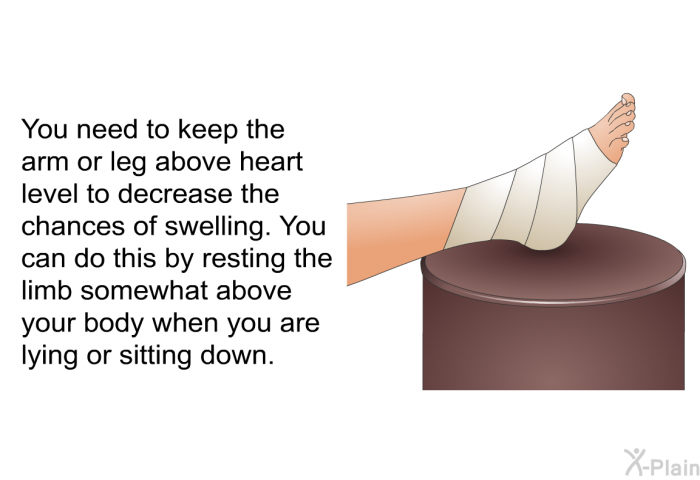 You need to keep the arm or leg above heart level to decrease the chances of swelling. You can do this by resting the limb somewhat above your body when you are lying or sitting down.