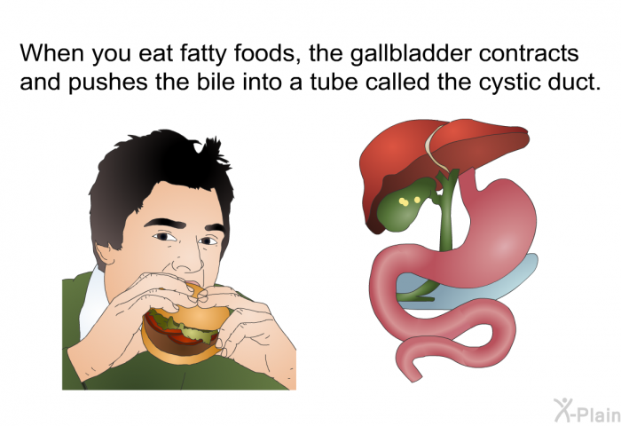 When you eat fatty foods, the gallbladder contracts and pushes the bile into a tube called the cystic duct.